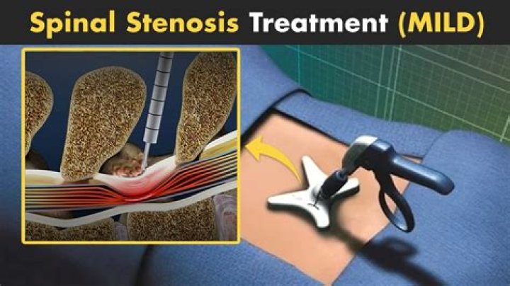What is mild lumbar stenosis?