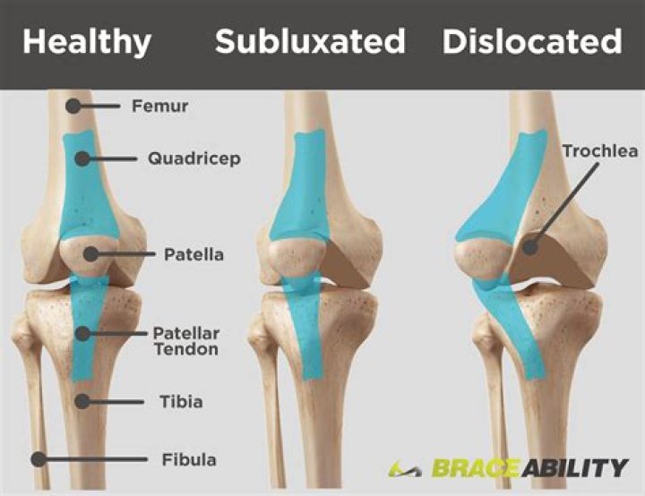 What is patellar subluxation?
