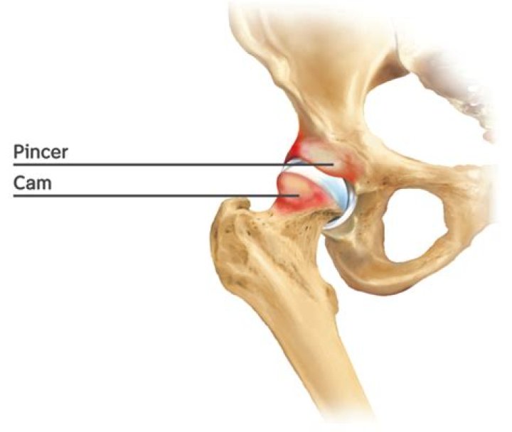 What is pincer impingement?