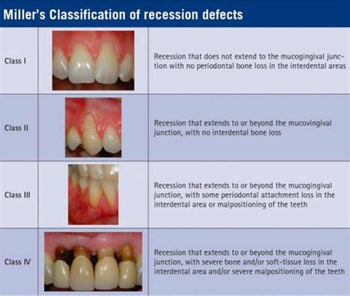What is recession in periodontics?