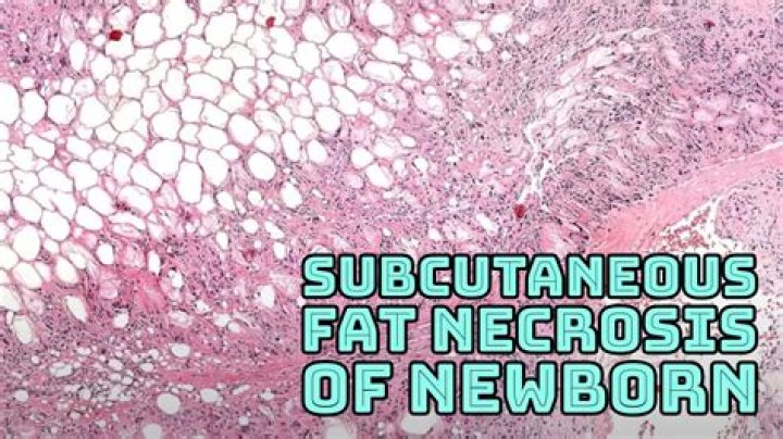 What is subcutaneous necrosis?