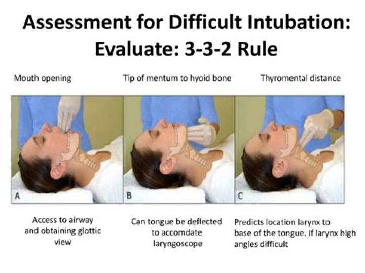 What is the 332 rule in intubation?