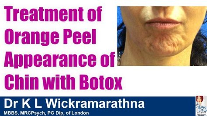 What is the best treatment for orange peel skin?