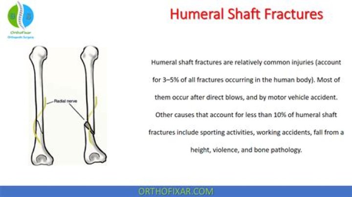 What is the commonest complication of fracture of mid-shaft of humerus?