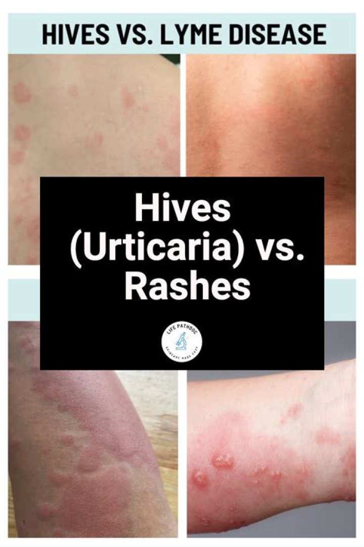 What is the difference between hives and urticaria?