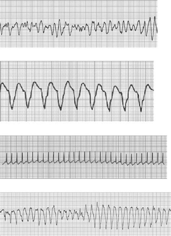 What is the difference between torsades de pointes and ventricular fibrillation?