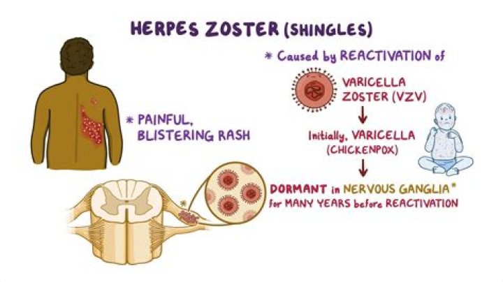 What is the main cause of herpes zoster?