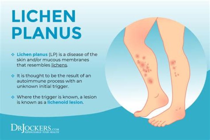 What is the main cause of lichen planus?