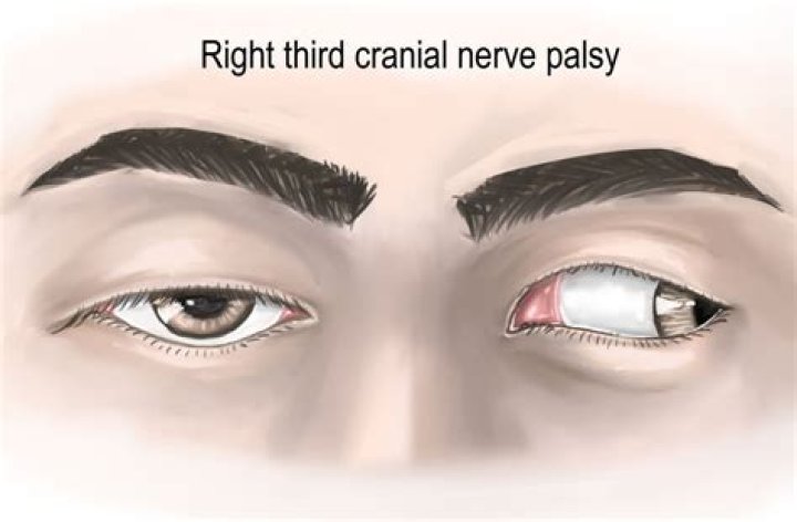 What is the most common cause of third nerve palsy?