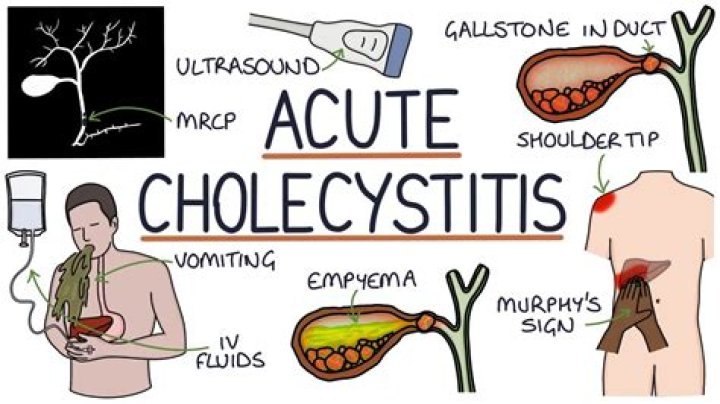 What is the pathophysiology of cholecystitis?
