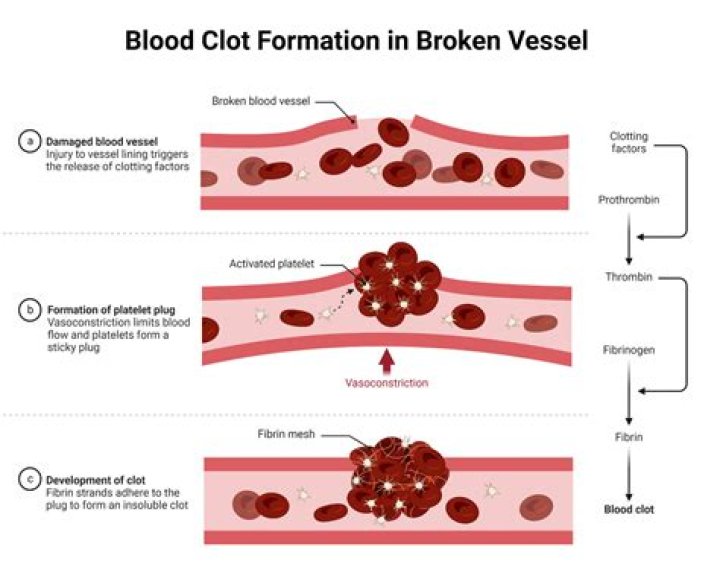What is the treatment of Hematocele?