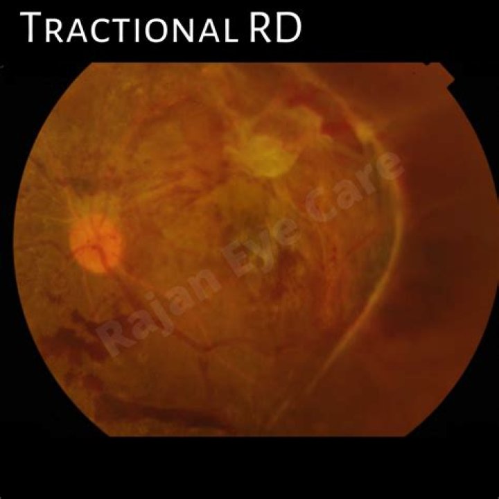 What is Tractional retinal detachment?