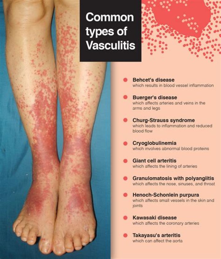 What is vasculitis of the nose?