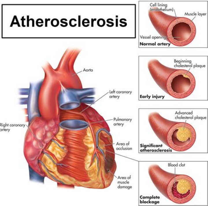What means arteriosclerosis?