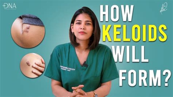 What ointment is good for keloids?