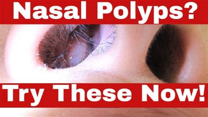 What to expect after having nasal polyps removed?