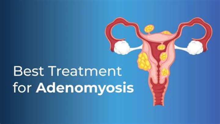 Which medicine is best for adenomyosis?
