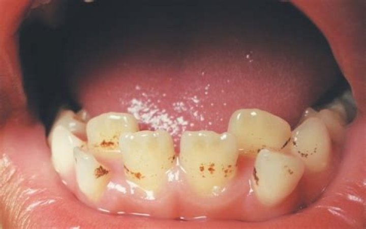 Why do I have brown lines on my back teeth?