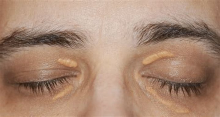 Why do my eyelids look like chicken skin?