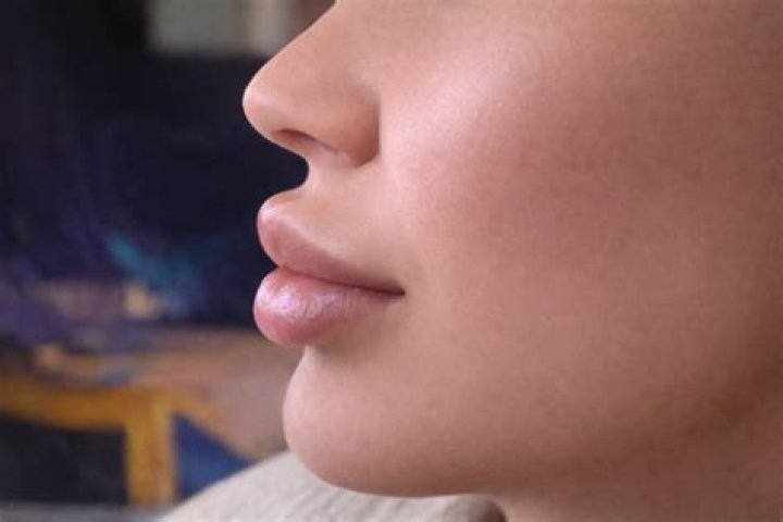 Why is it called Duck lips?